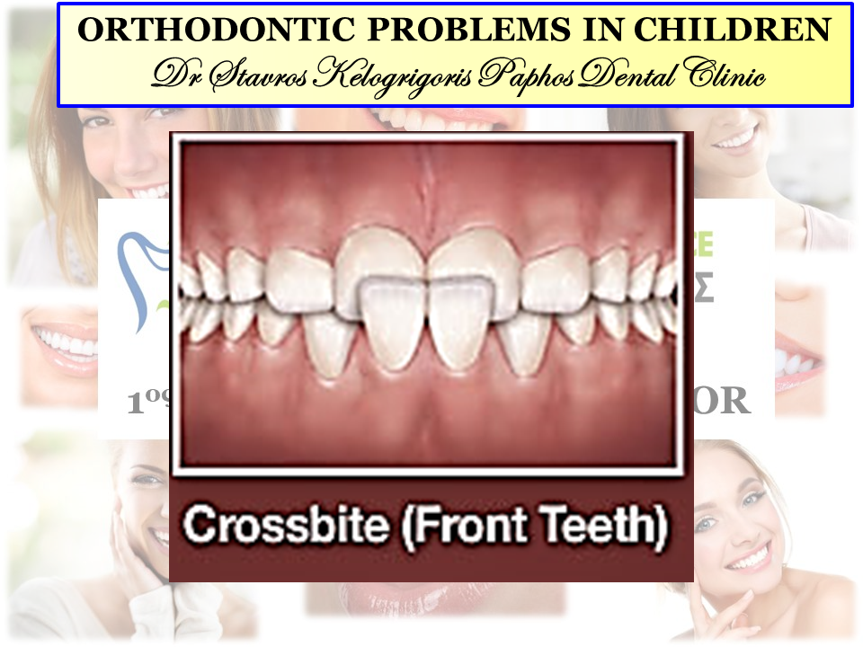underbite